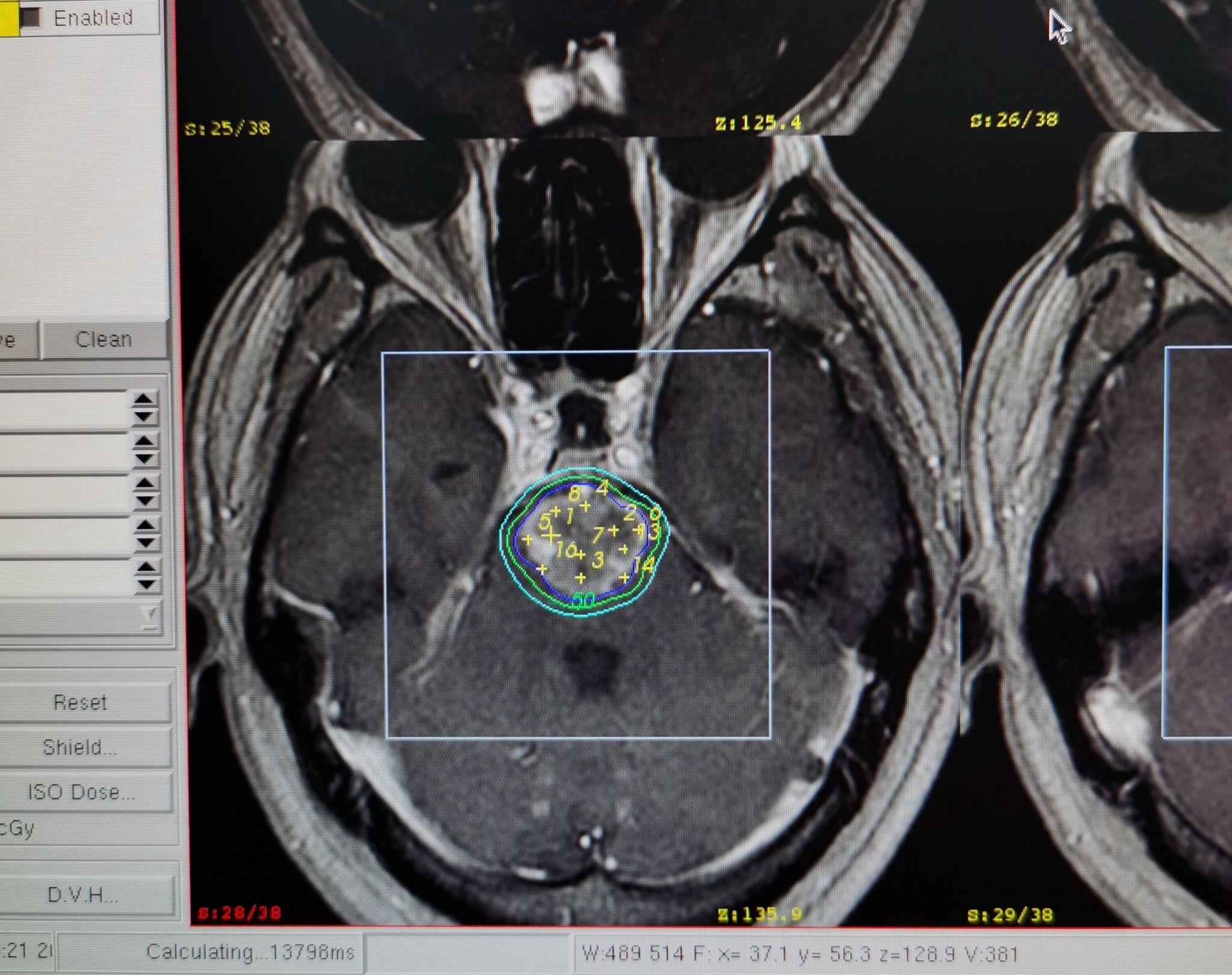 脑白质病变系列——放射性脑损伤_医学界-助力医生临床决策和职业成长