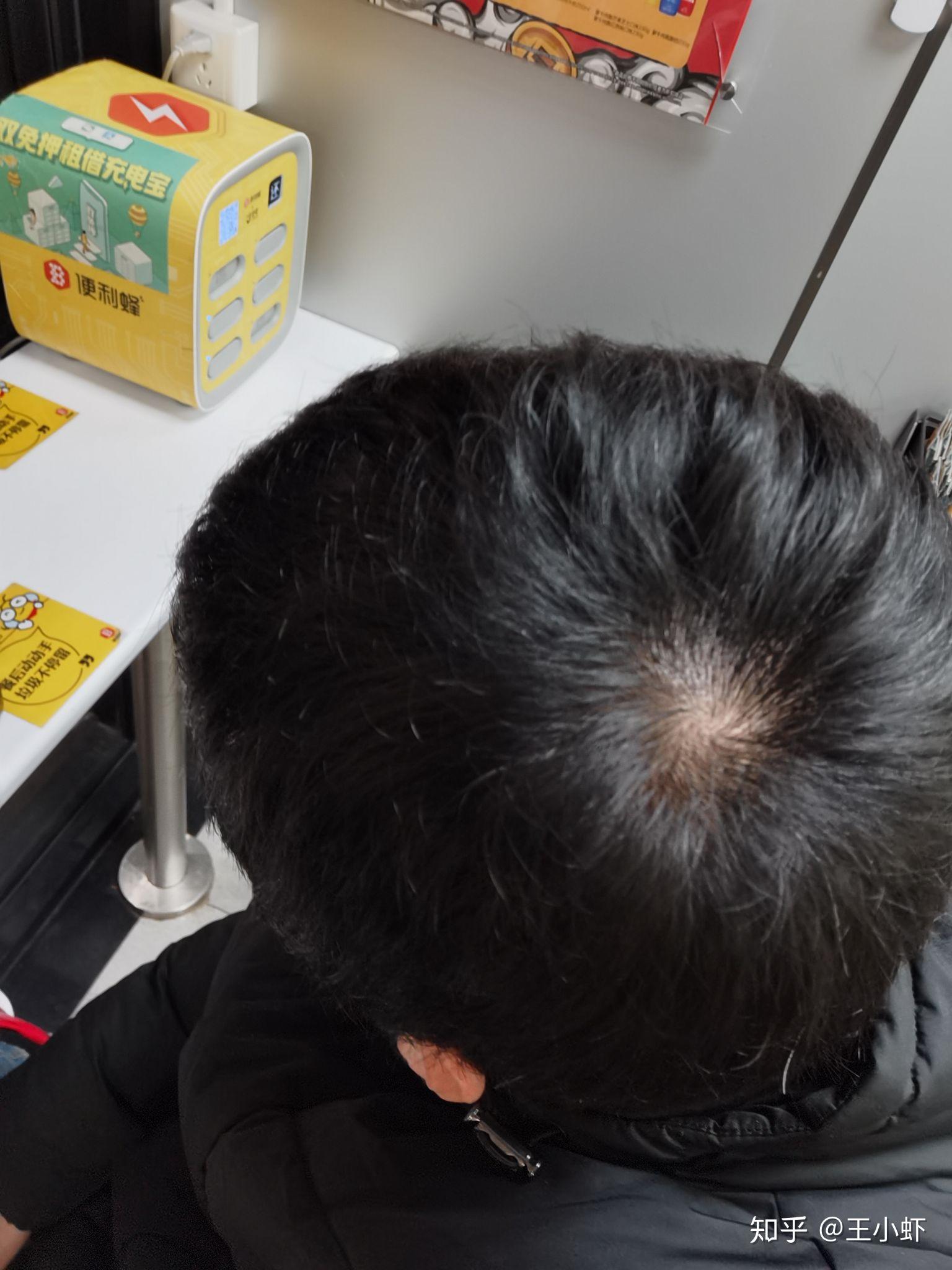 什么样子的发旋是正常的啊? - 知乎