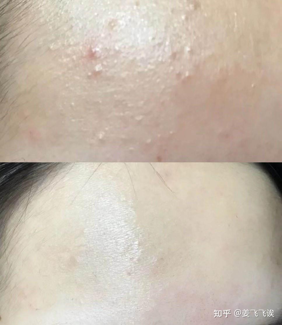 黑头、痘痘、闭口粉刺多,李佳琦推荐的果酸洗面奶真的有用吗? - 知乎