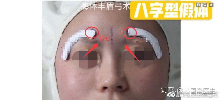 眉弓假体形状选择指南:八字型/一字型/一片式哪种类型适合你?