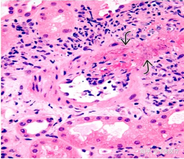 纤维蛋白样坏死,透壁,较多苏木素小体,管周巨噬细胞浸润著.