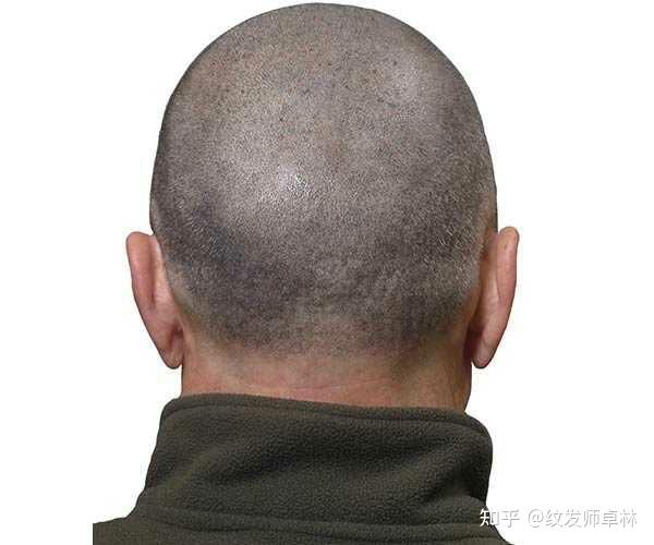 植发后脑勺取成这样算不算毁容