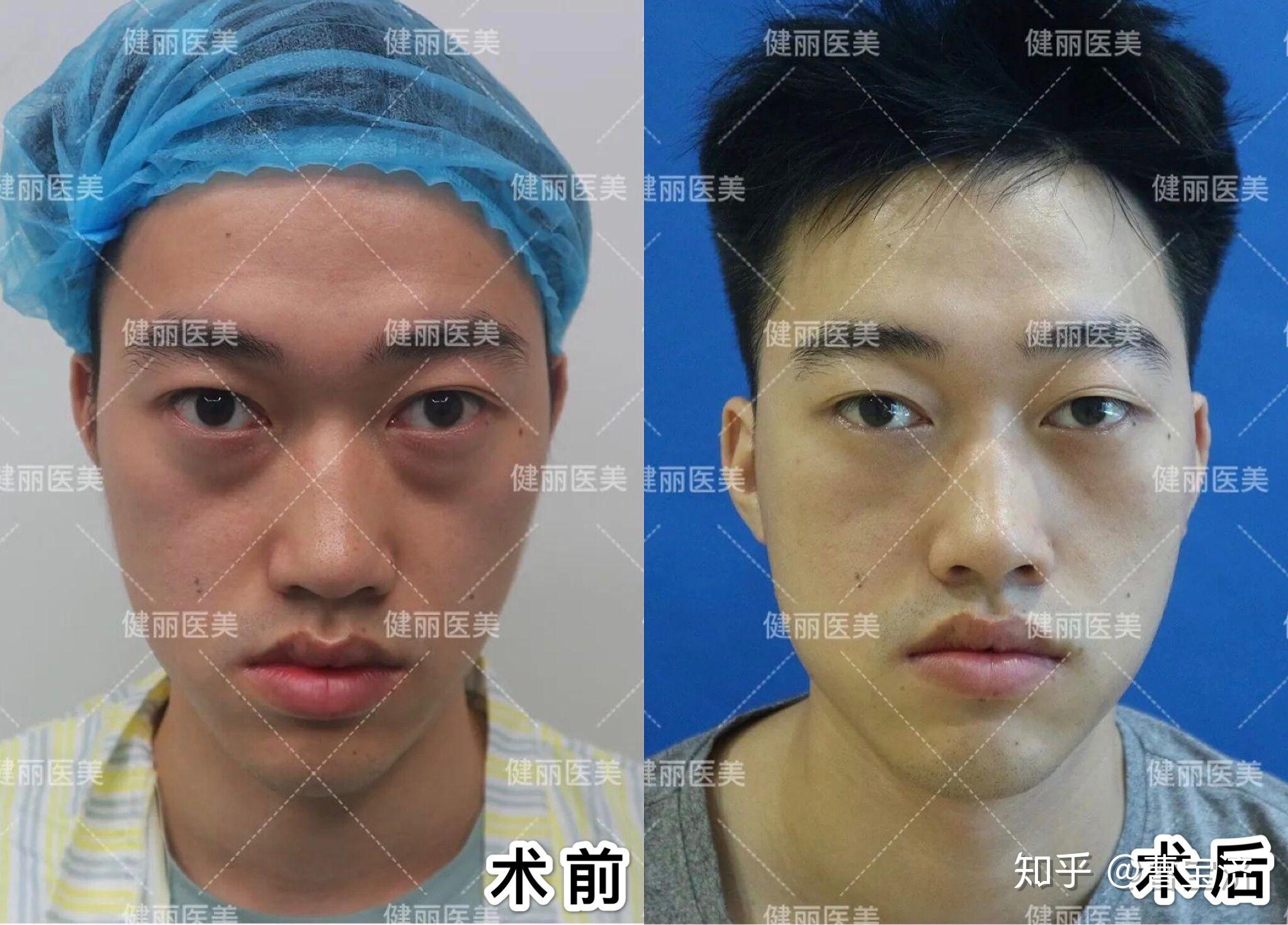 泪沟可不可以自然去除? - 知乎
