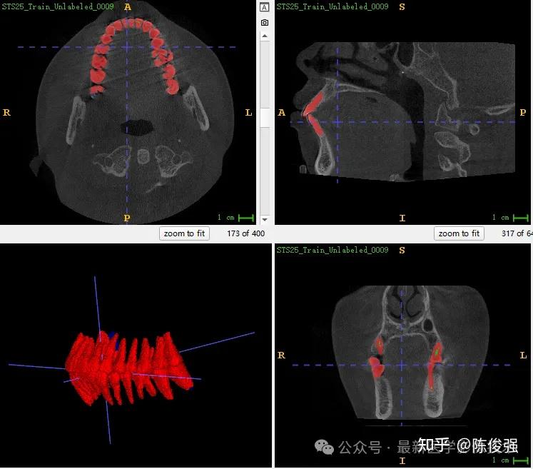 STSR2025——CBCT牙齿分割和CBCT与IOS注册配准 - 知乎