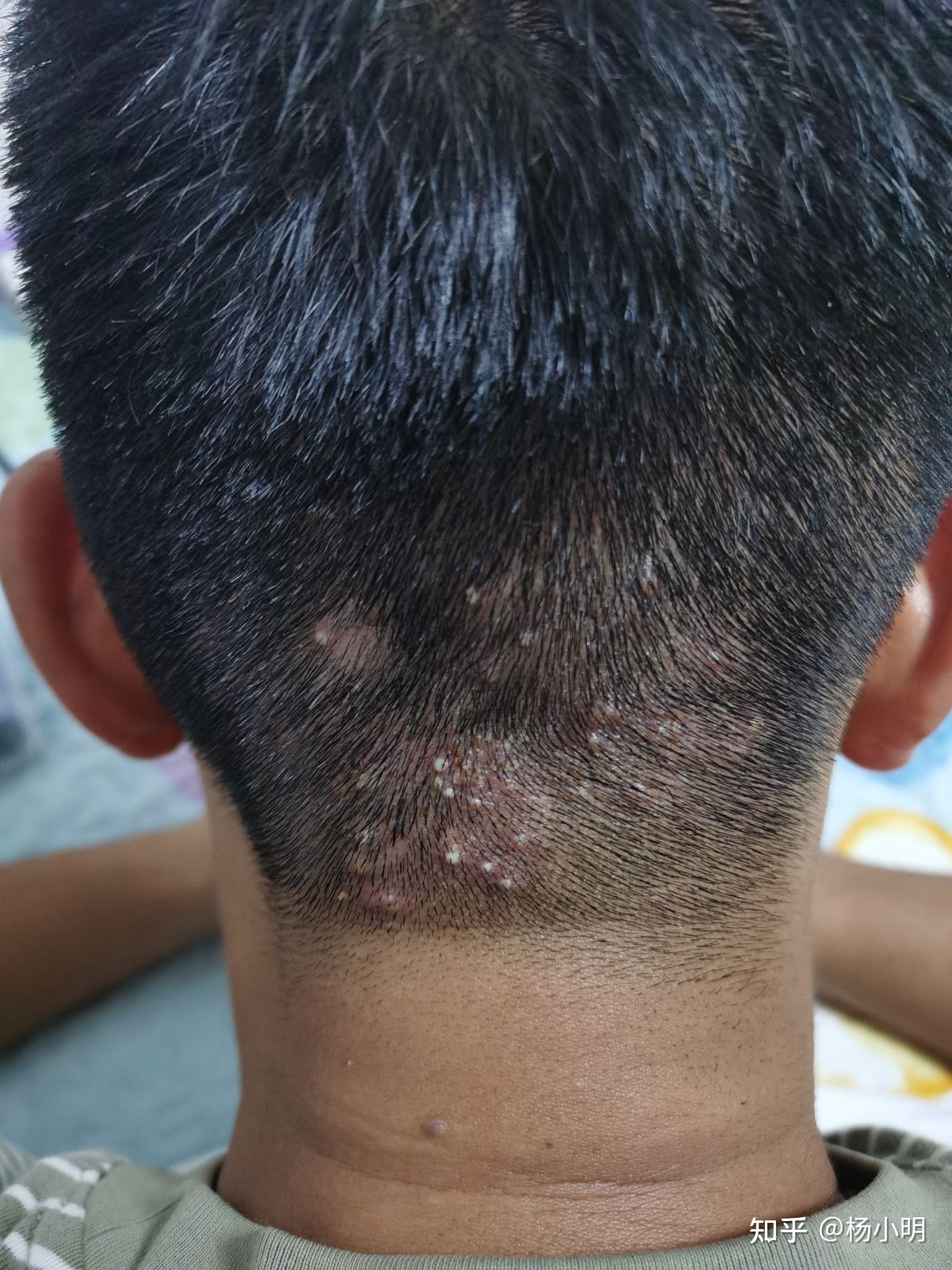 脑袋后面长了好多小疙瘩