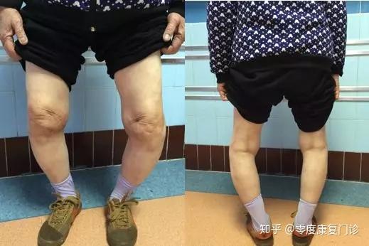 广州零度膝关节骨性关节炎膝关节疼痛膝盖疼必做膝关节置换吗