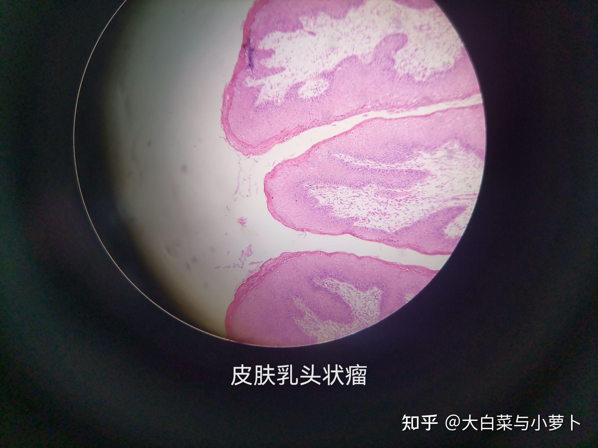 癌巢内可见鳞状细胞角化过程3高分化者可见角化珠和细胞间桥