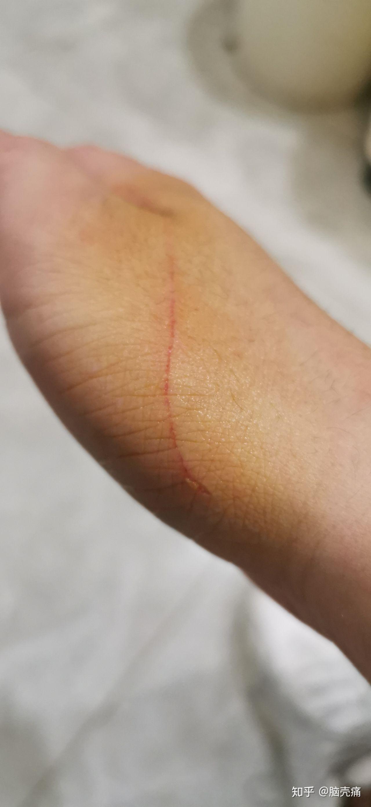 猫抓伤伤痕特点有图图片