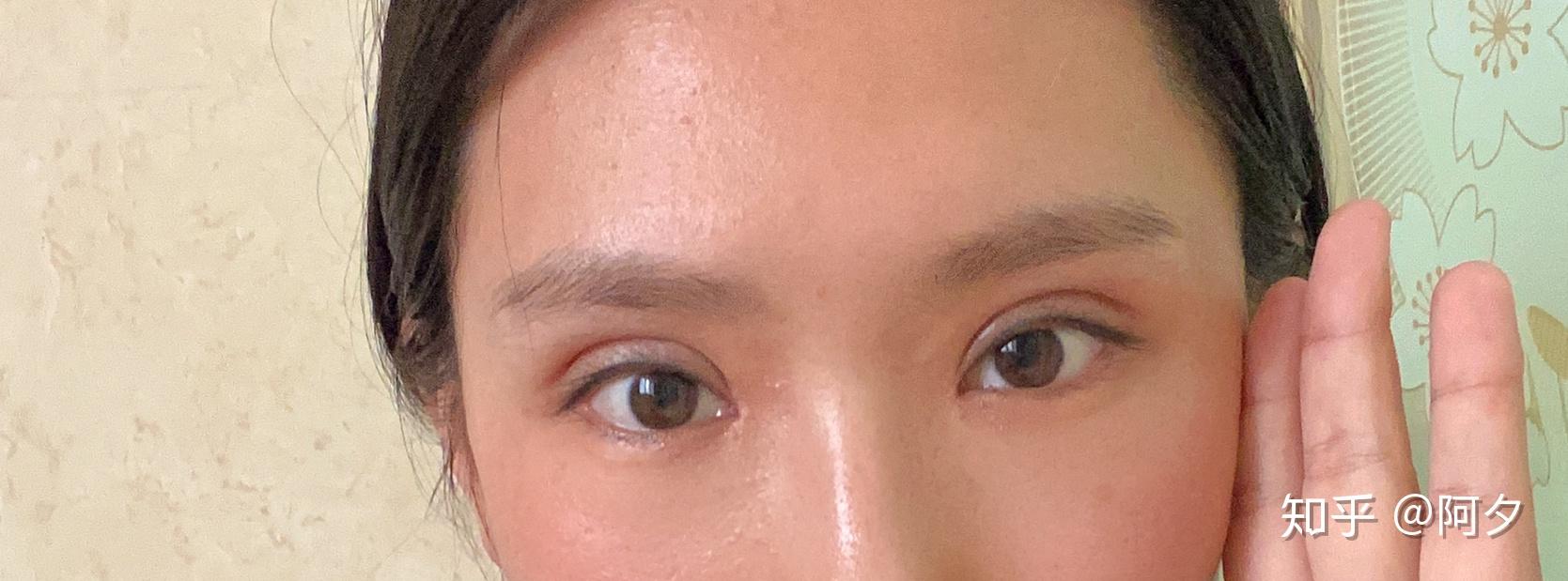 埋线双眼皮后有肉条感,怎么样调整心态?