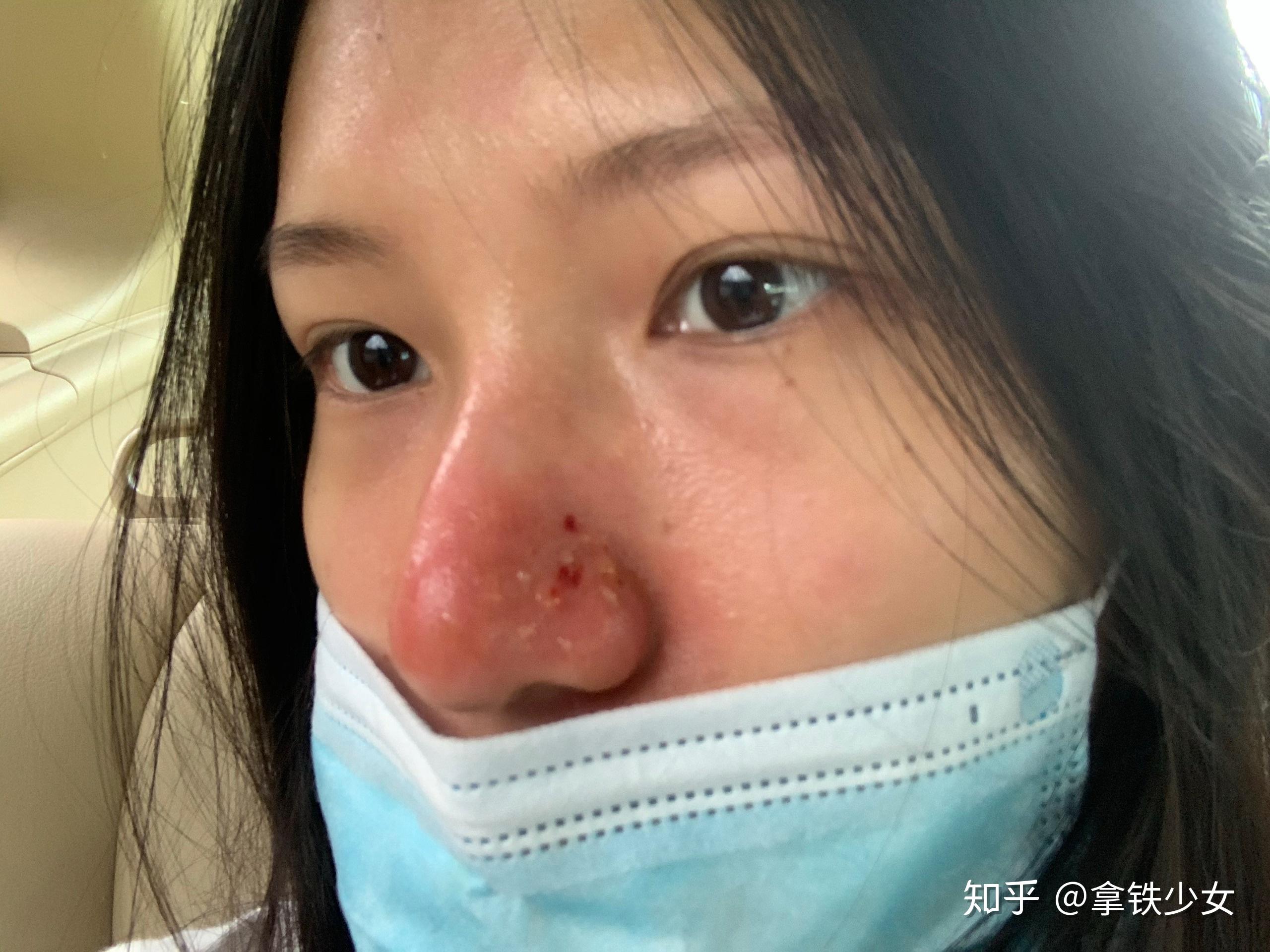 女孩子有酒糟鼻是什么样的体验