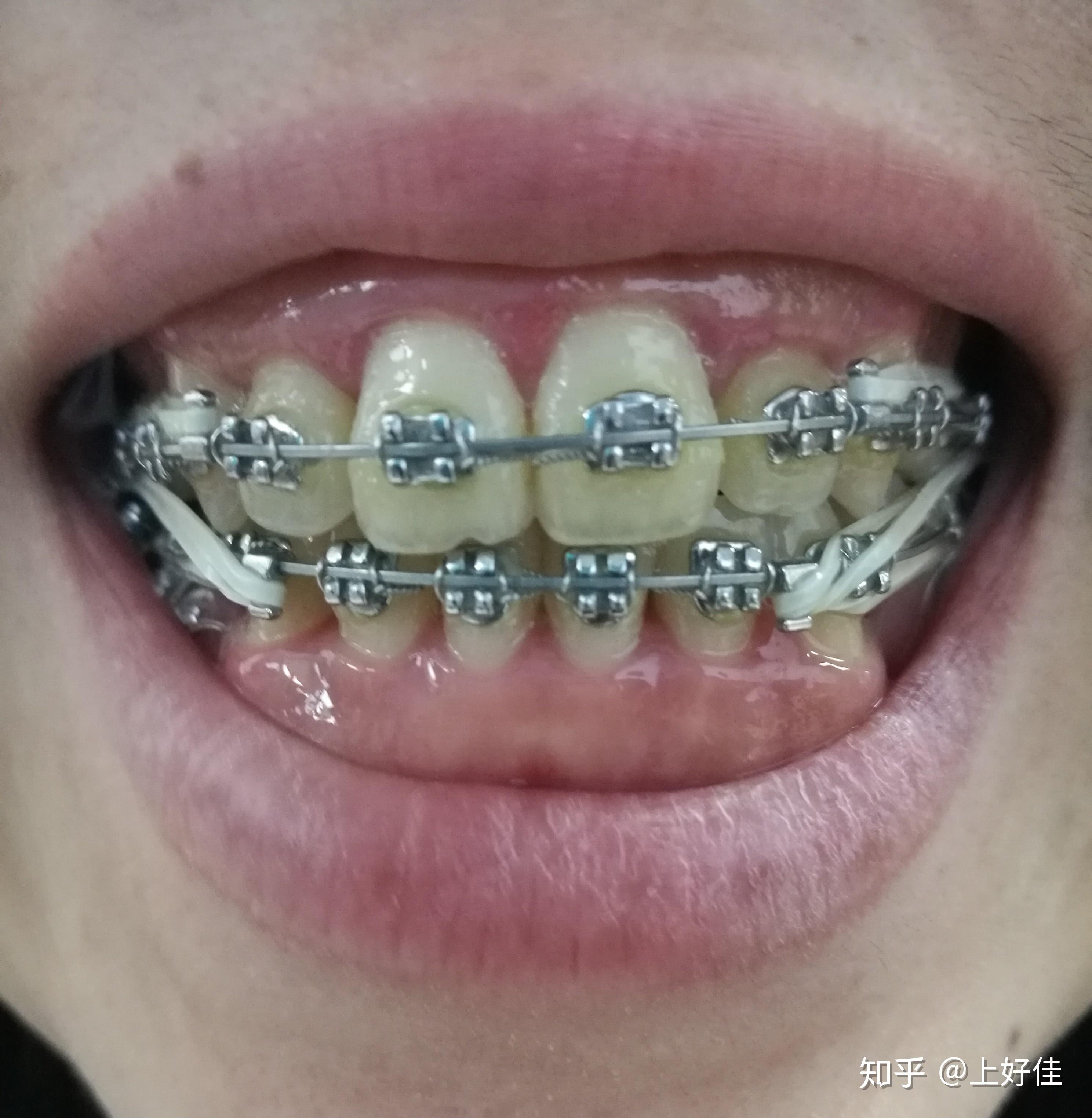 全同步带状弓整牙日记(每周一更,完更)20年6月-24年3月