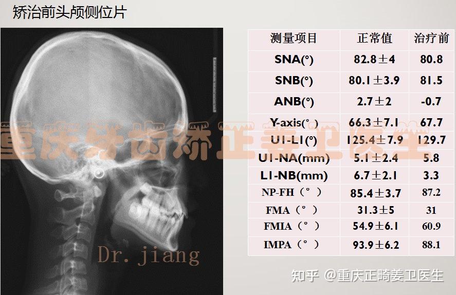 13阻生67颜面软组织 面下1/3稍长