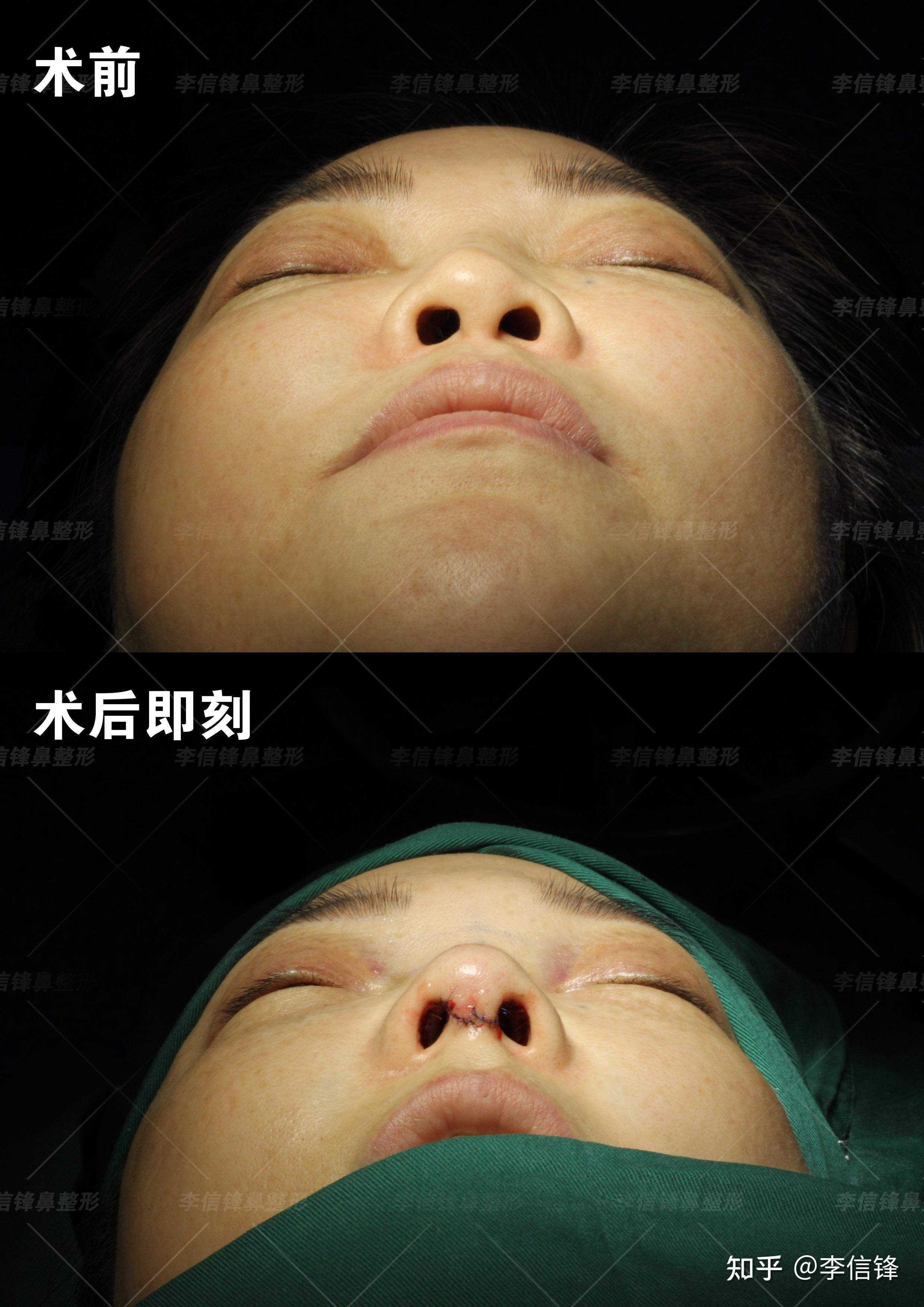 云南过来的姑娘,多年前做过假体隆鼻,现鼻子塌、面中平、漏鼻孔等问题,现在修复完术后即刻对比效果显著!深圳李信锋隆鼻综合整形案例分享 - 知乎