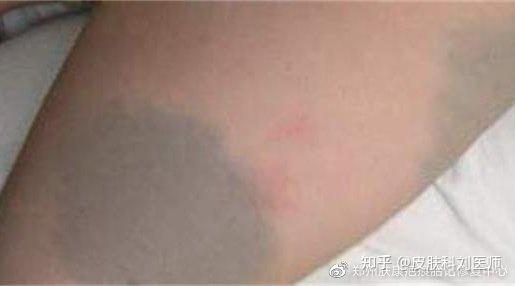 胎记的种类和治疗方法,你都了解多少? - 知乎