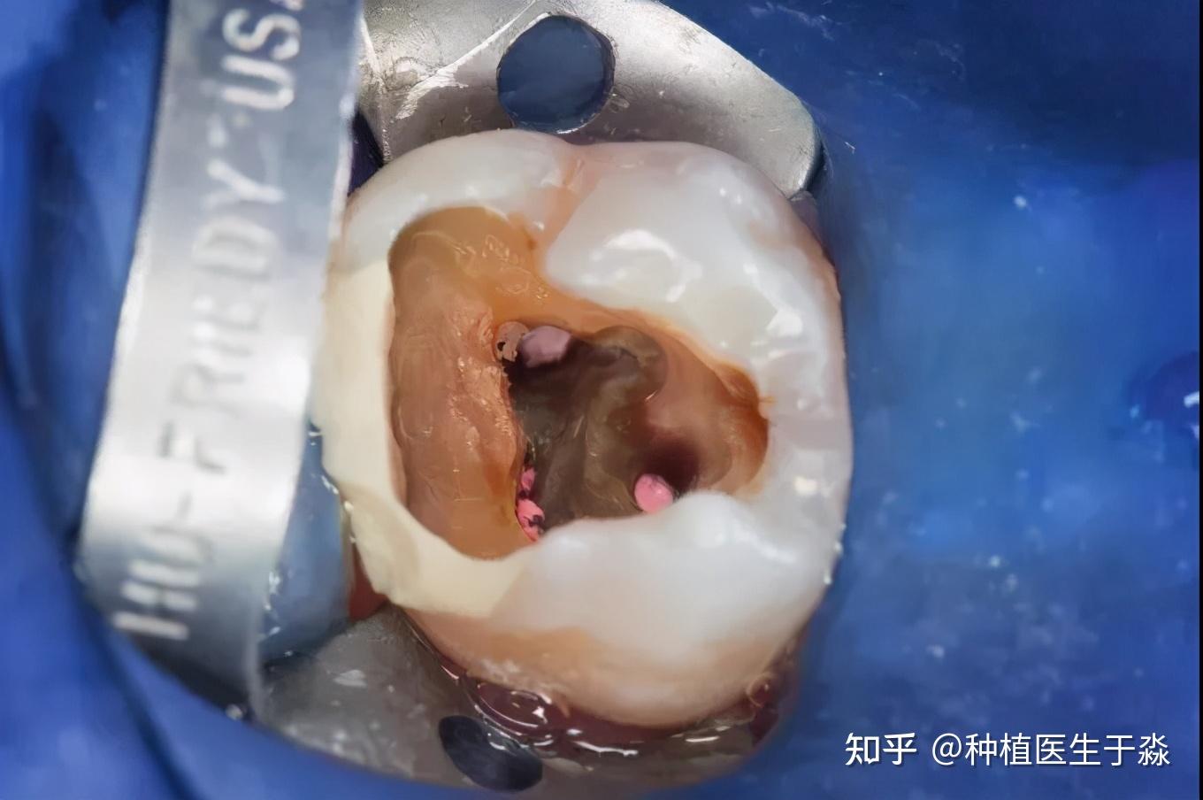 遇到这3种情况牙齿就该做根管治疗了