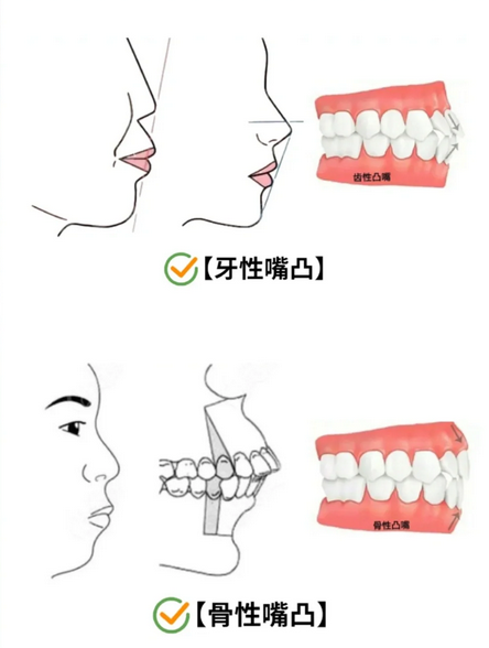 龅牙怎么矫正图片