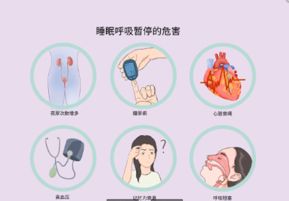 鼾症,俗称打呼噜 - 知乎