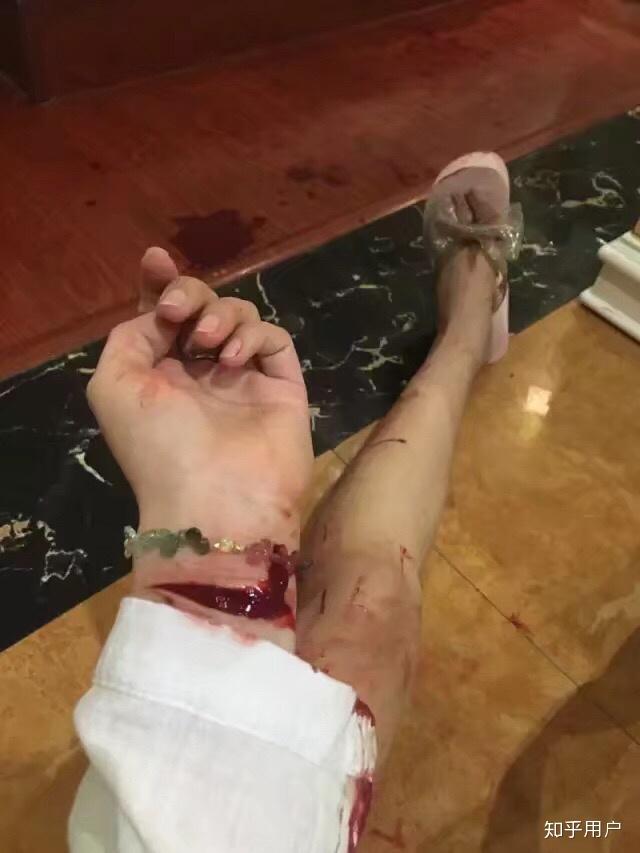 为什么割腕会死人而断臂的人却能活着