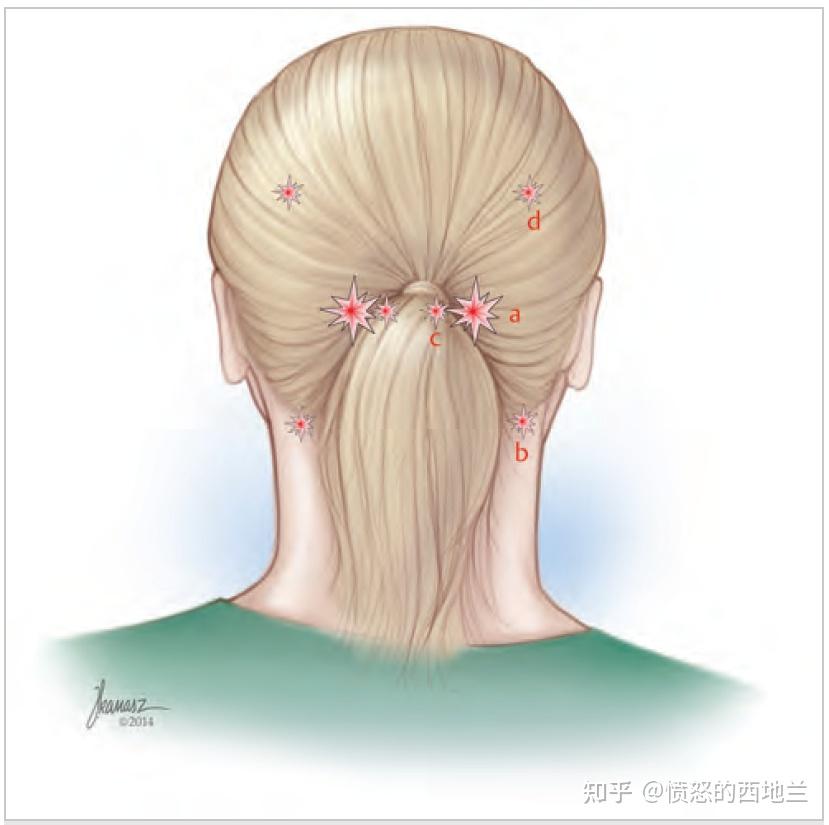 難治性枕神經痛的微創手術治療枕小神經痛