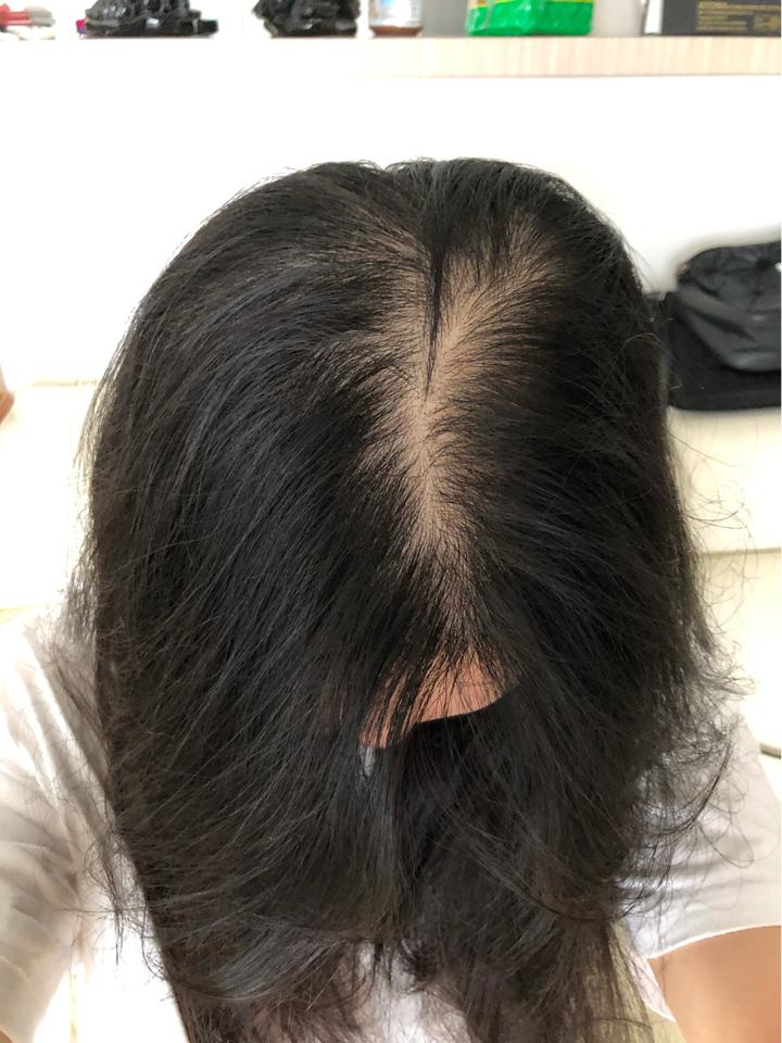 发缝处为什么更容易脱发? - 知乎