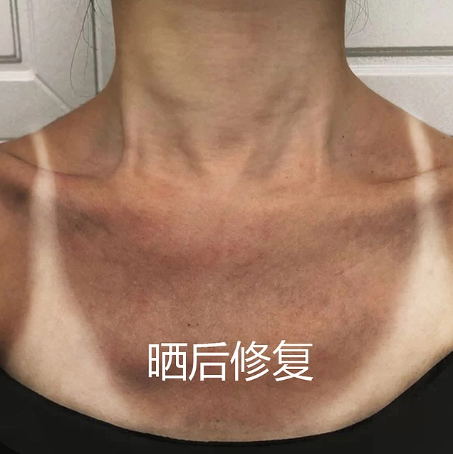 皮肤晒黑了怎么快速变白的最快修复方法,有什么美白修复小妙招? - 知乎