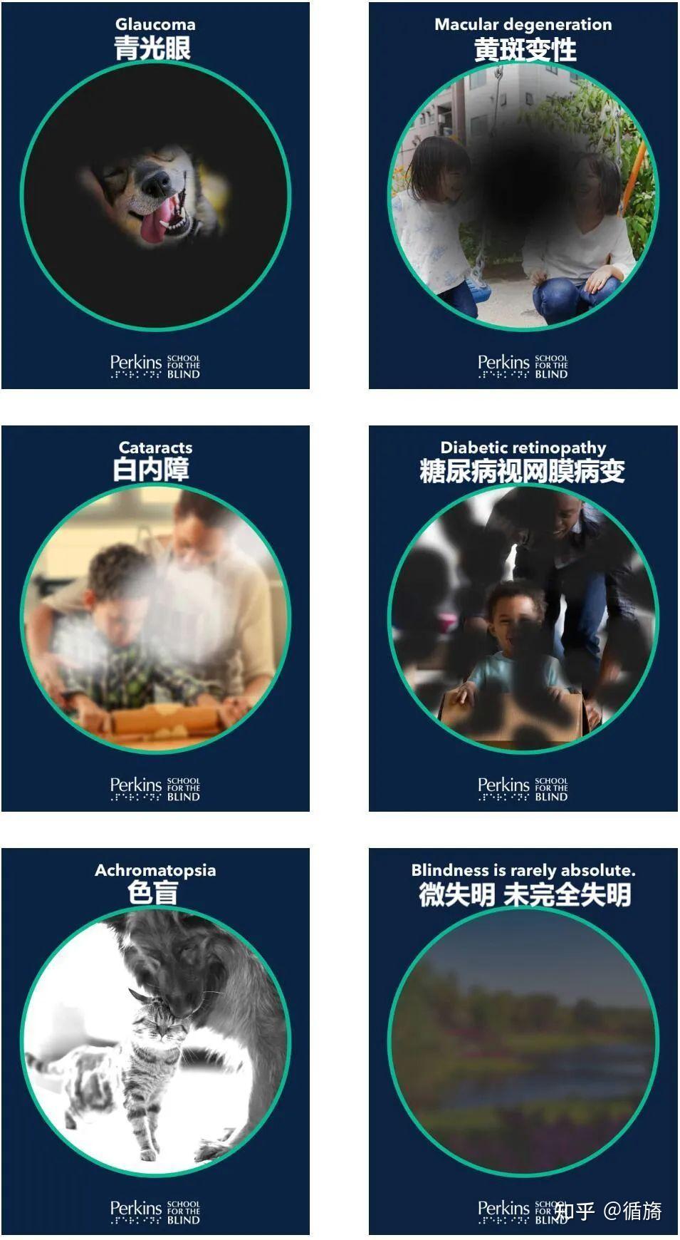 CVI皮质盲:由大脑视觉通路或视觉处理区域受损引起的脑/皮质视觉障碍 - 知乎