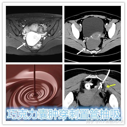 巧克力囊肿ct图片