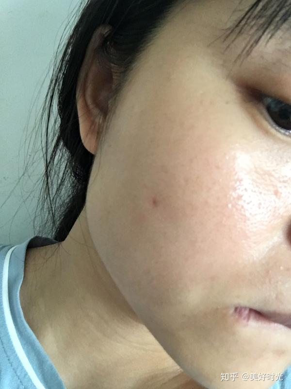 就一个痘坑几年了有办法弄好吗