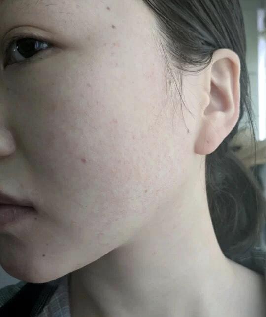 毛周角质发生在脸上如何改善