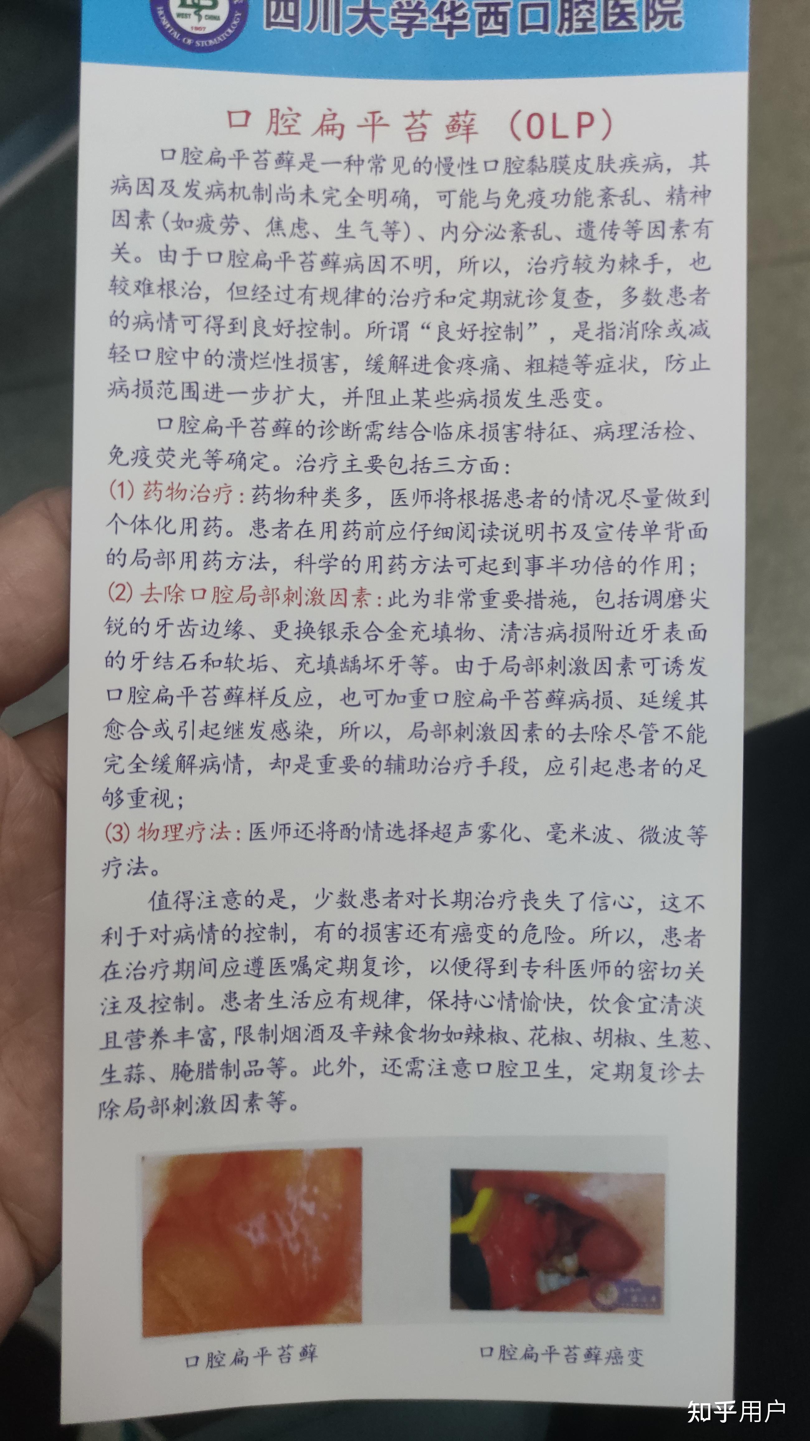 口腔扁平苔藓能治好吗? - 知乎