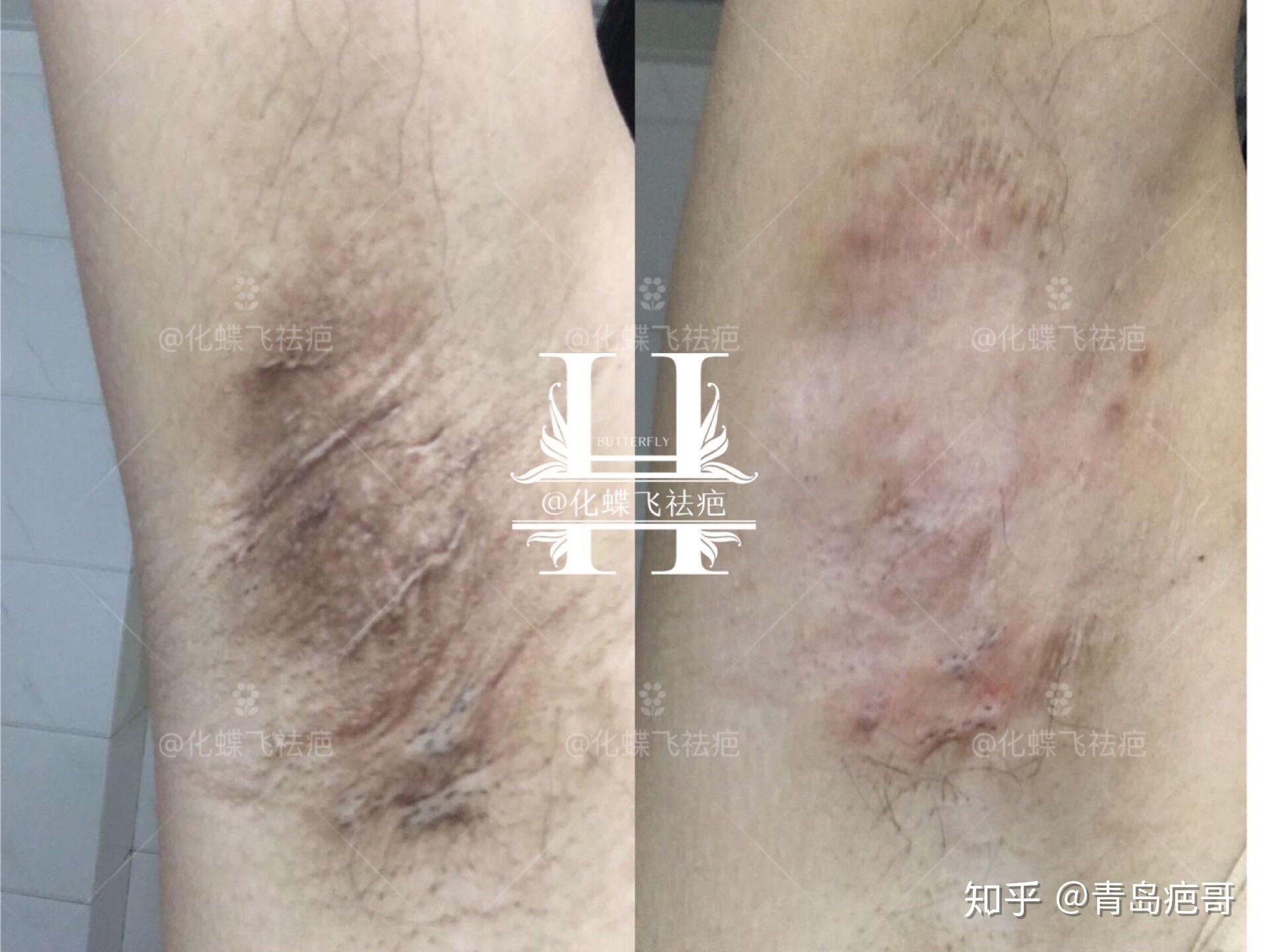 哺乳期宝妈七八年的腋下手术疤痕