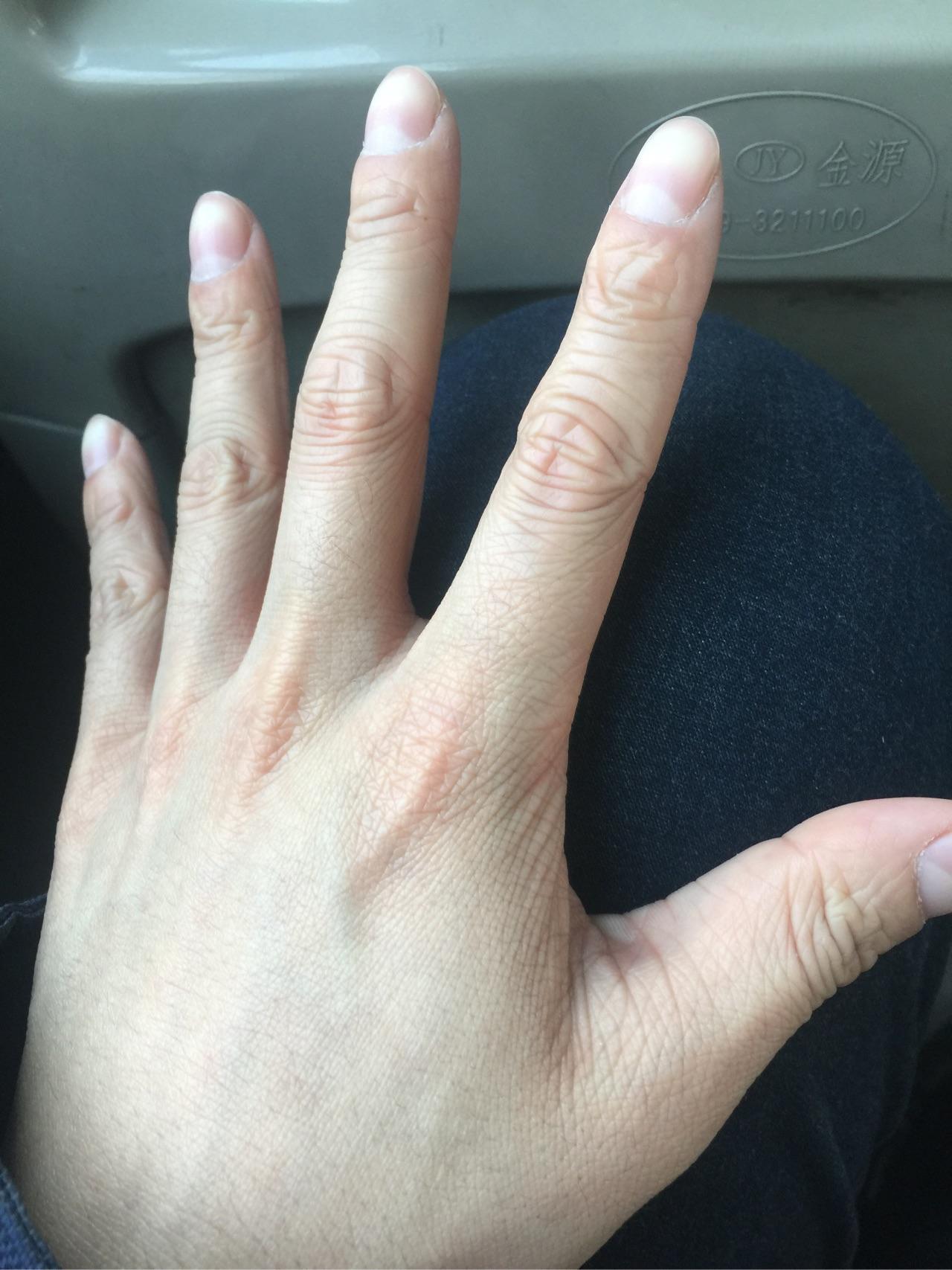 年纪轻轻23岁手上皮肤就很干有很多皱纹,像老年人干瘪的手,怎么办呀?