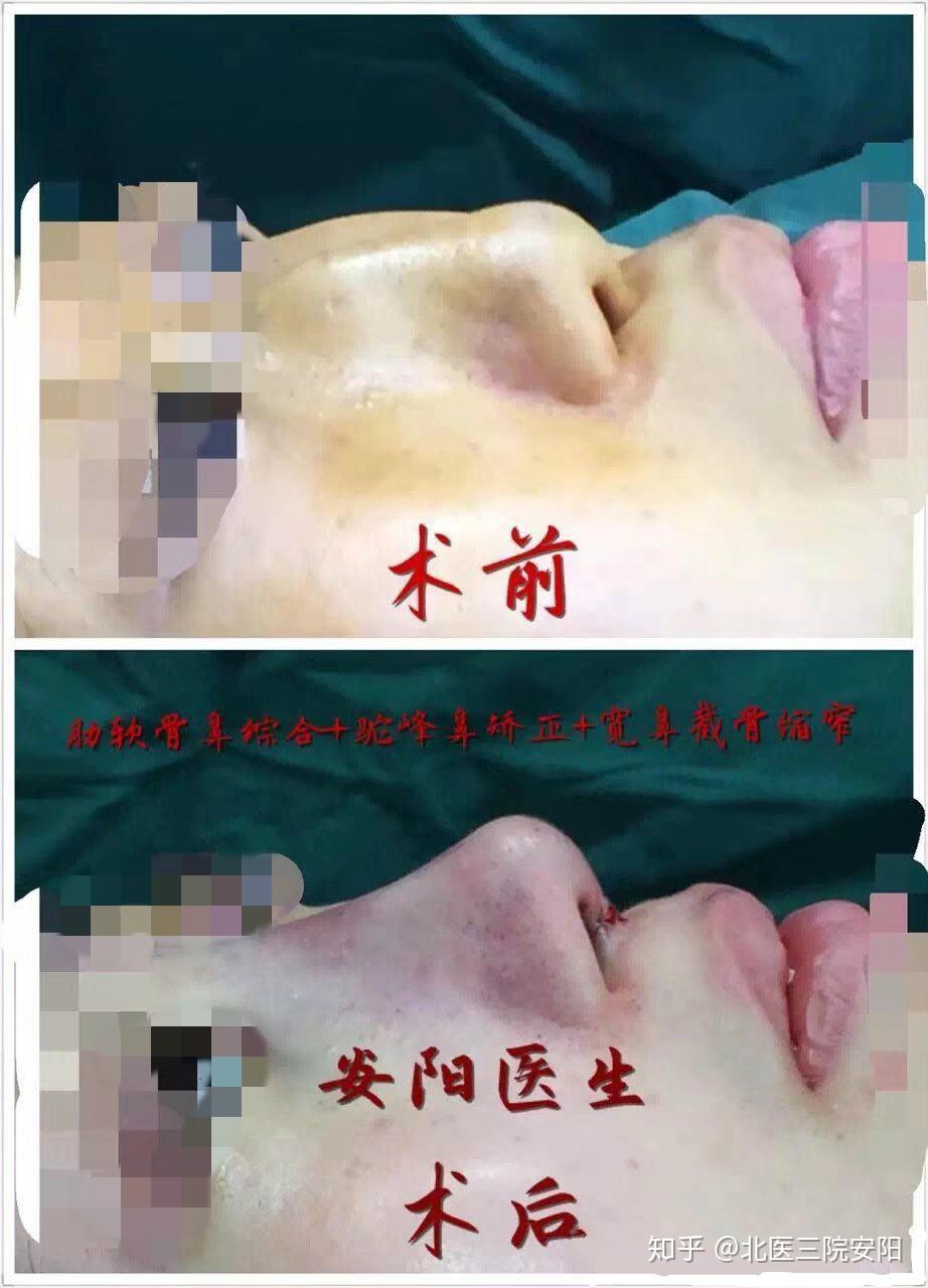 侧面术前术后即刻对比手术方案:肋软骨鼻综合 驼峰鼻矫正 宽鼻截骨缩