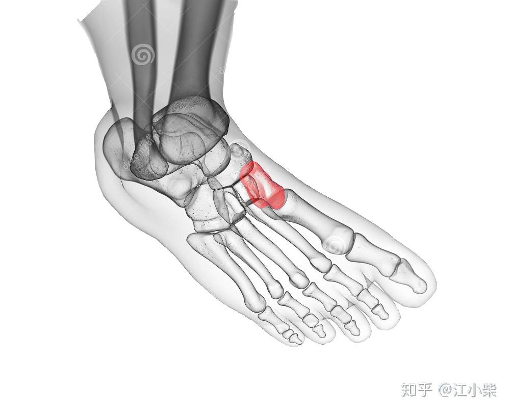 足舟骨突出疼痛該怎麼治療? - 知乎