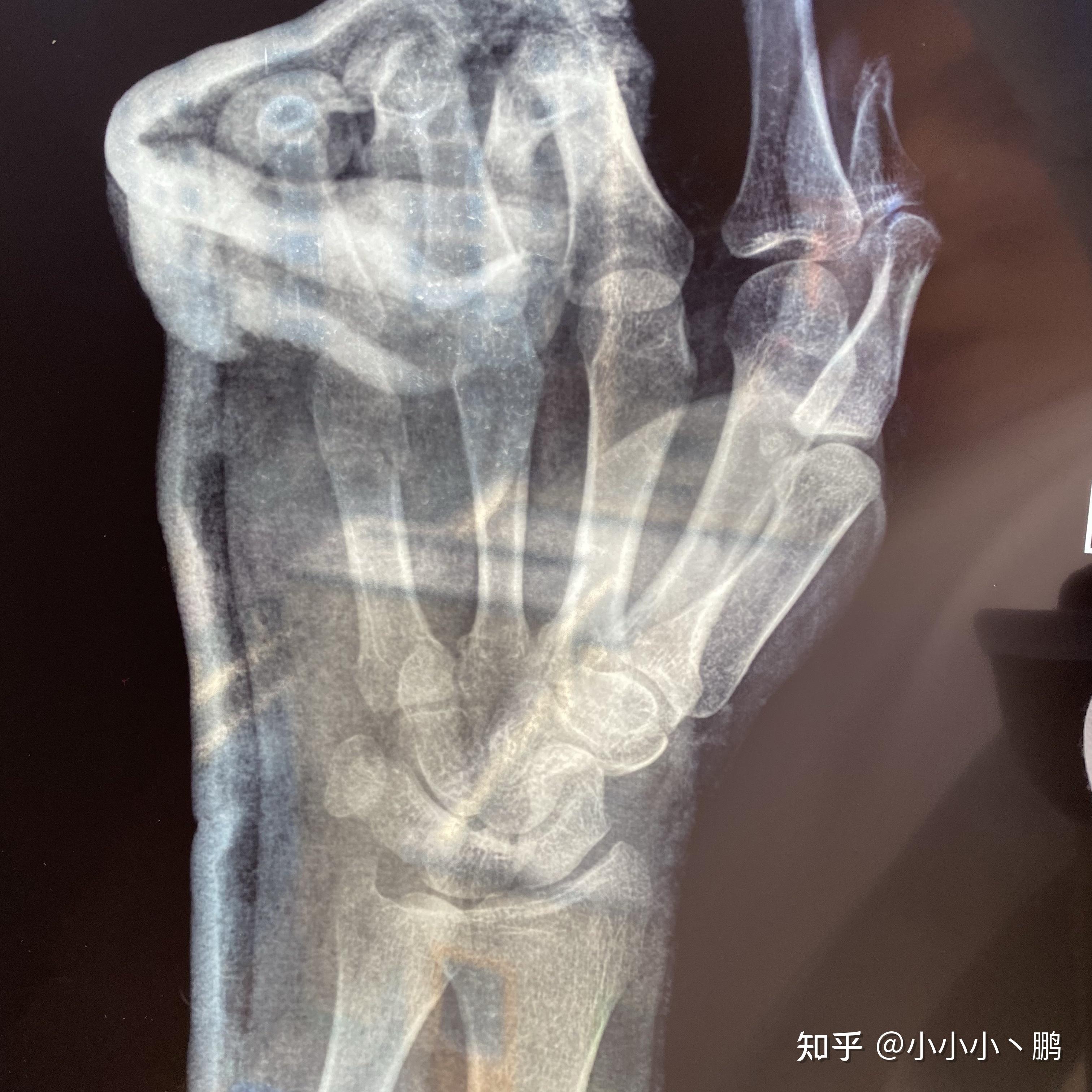 接骨院 志木｜ほねつぎの技術：手の小指の骨折