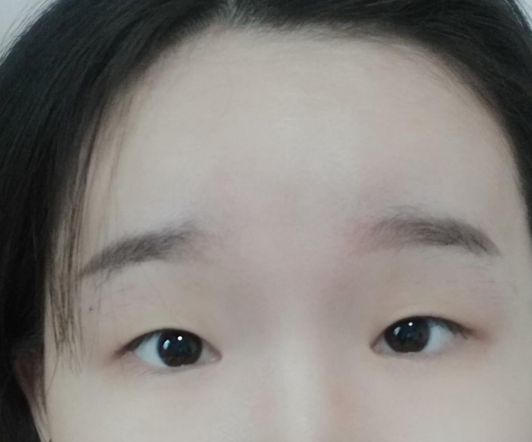 咨询案例 八字眉 小眼睛该如何改善?