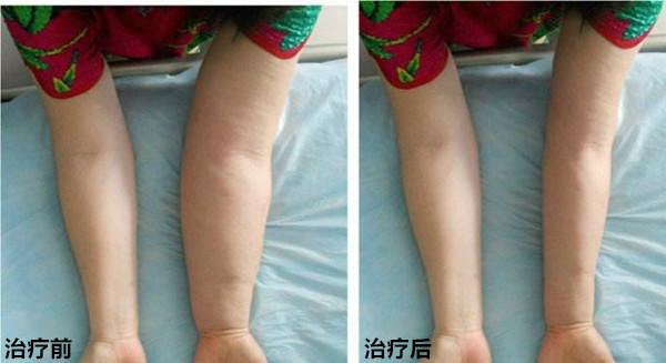 乳腺癌术后出现的手臂水肿其实是一种淋巴水肿,是由于腋窝手术或放射