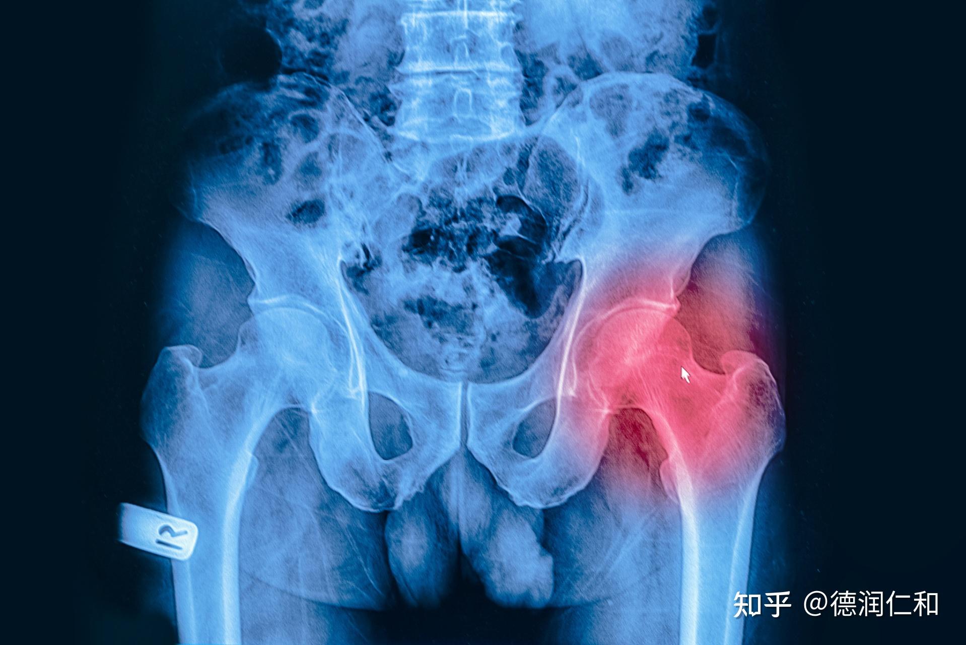 股骨头坏死有那些表现?
