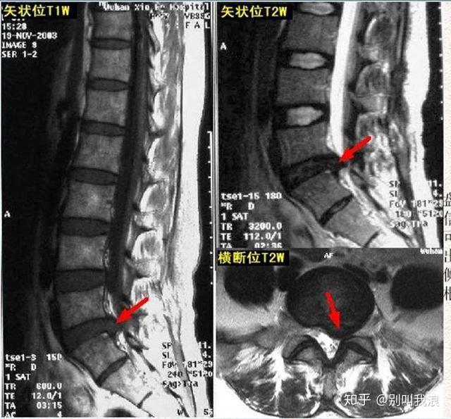 腰椎间盘突出治疗应该个体化不是所有的都需要医生治疗