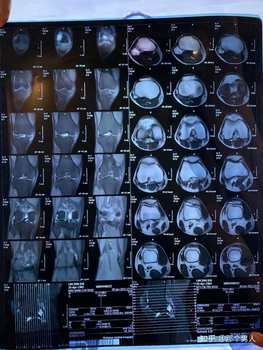 膝盖CT正常图片图片