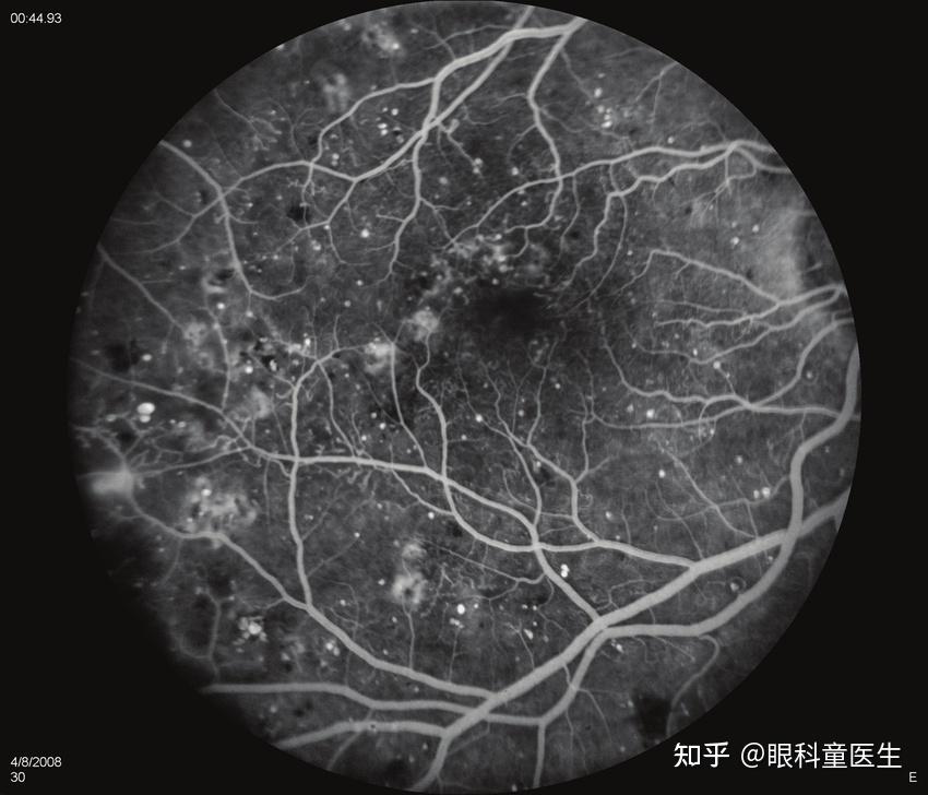 视网膜静脉阻塞(retinal vein occlusion, rvo)