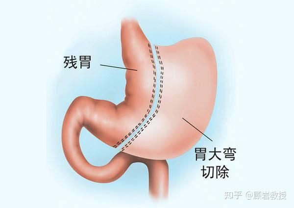 手术减肥_减肥手术多少钱_减肥手术是怎么做的