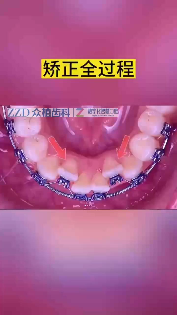 牙齿矫正的过程一起来看看