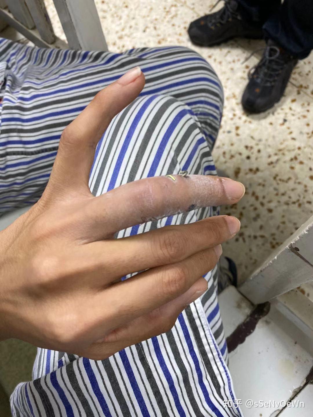 手指头骨折是种怎样的体验? - 知乎