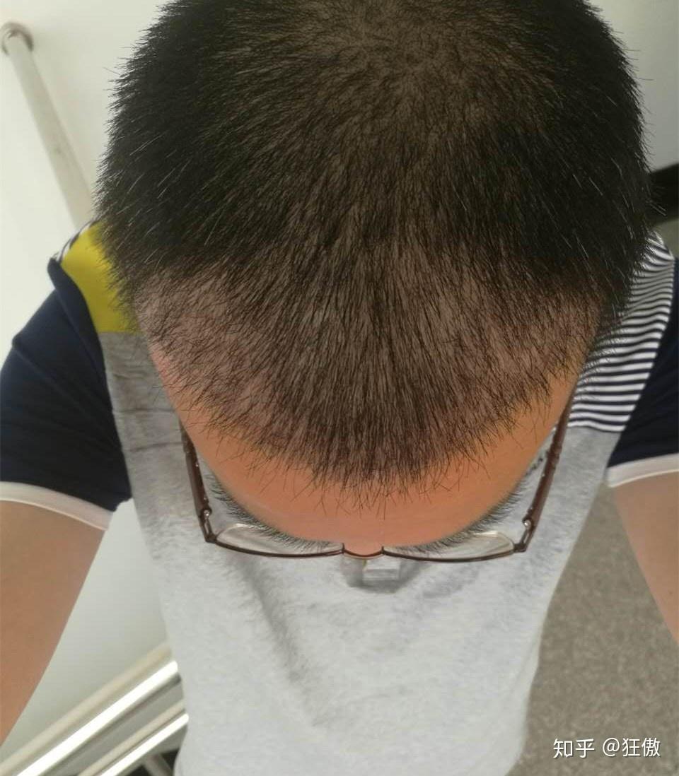 为什么秃顶的人这么多很少有做植发的?