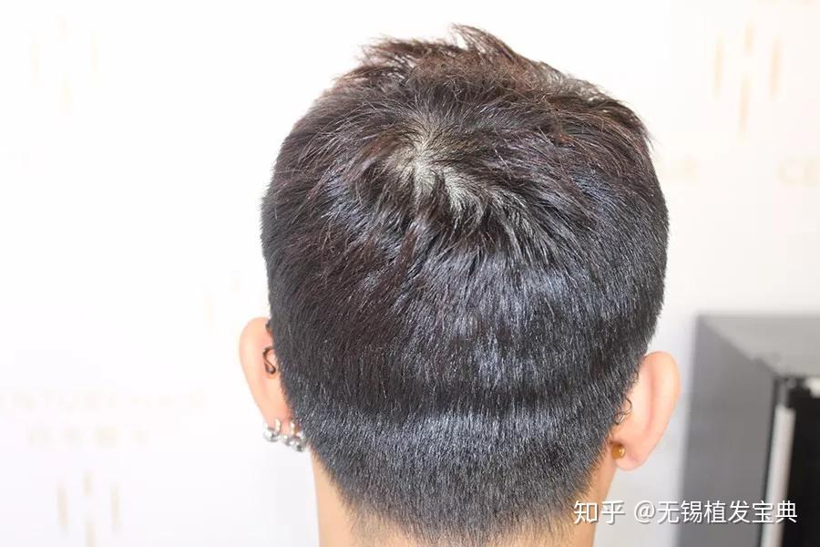【无锡植发】种植密度如何算?额角种植2500单位彻底摆脱M秃 - 知乎