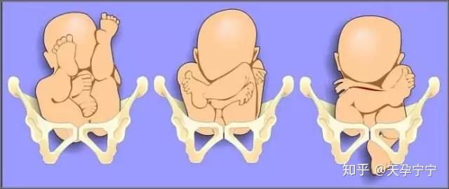 胎位不正怎么办?有什么解决方案? - 知乎