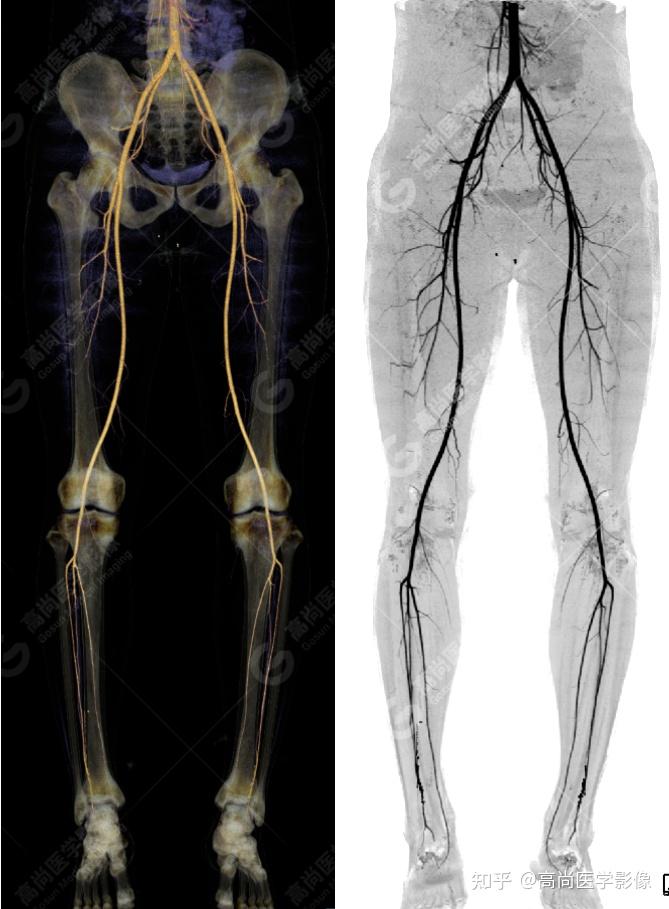 下肢动脉炎图片