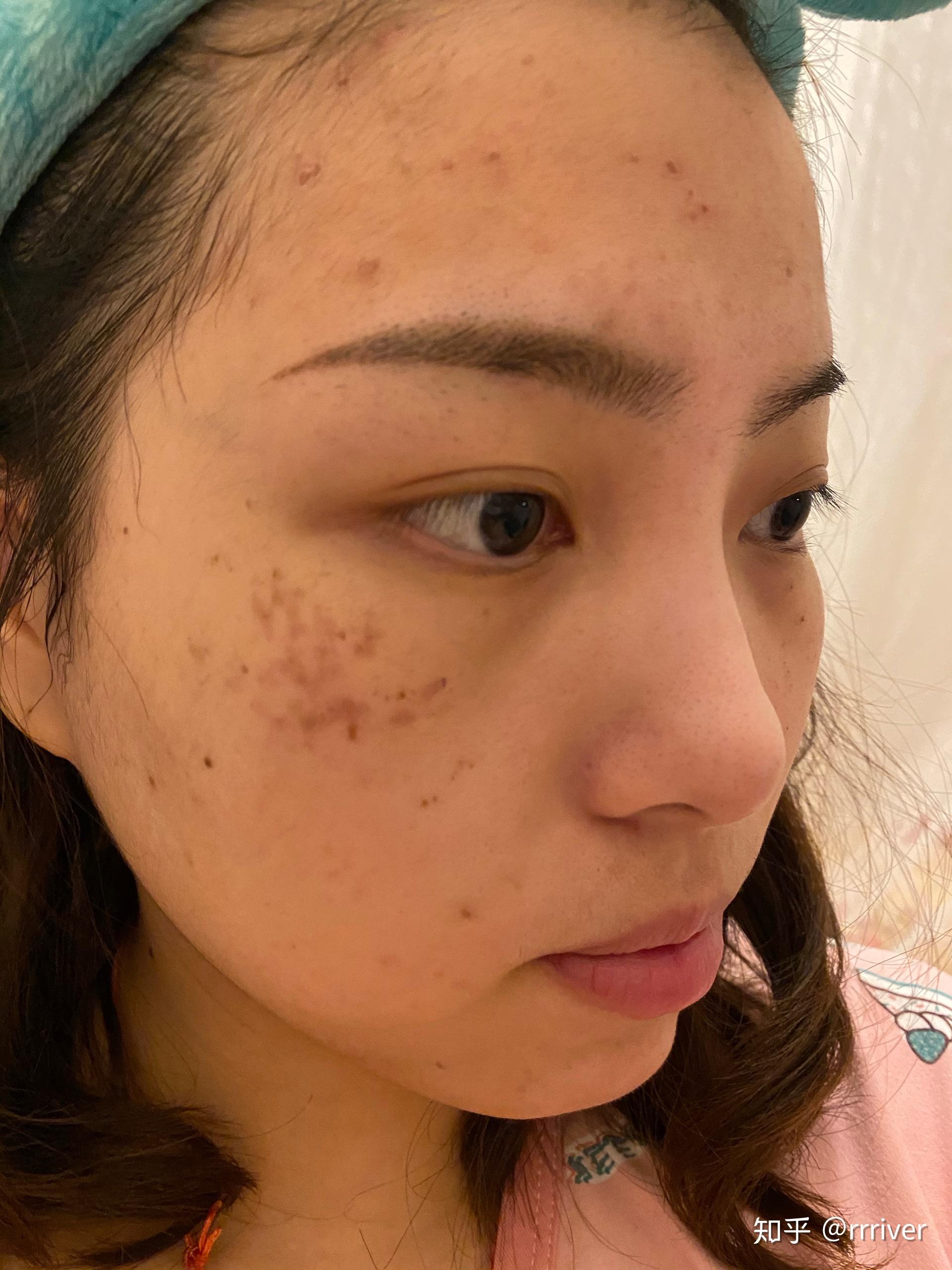 有谁褐青色痣治好过? - 知乎