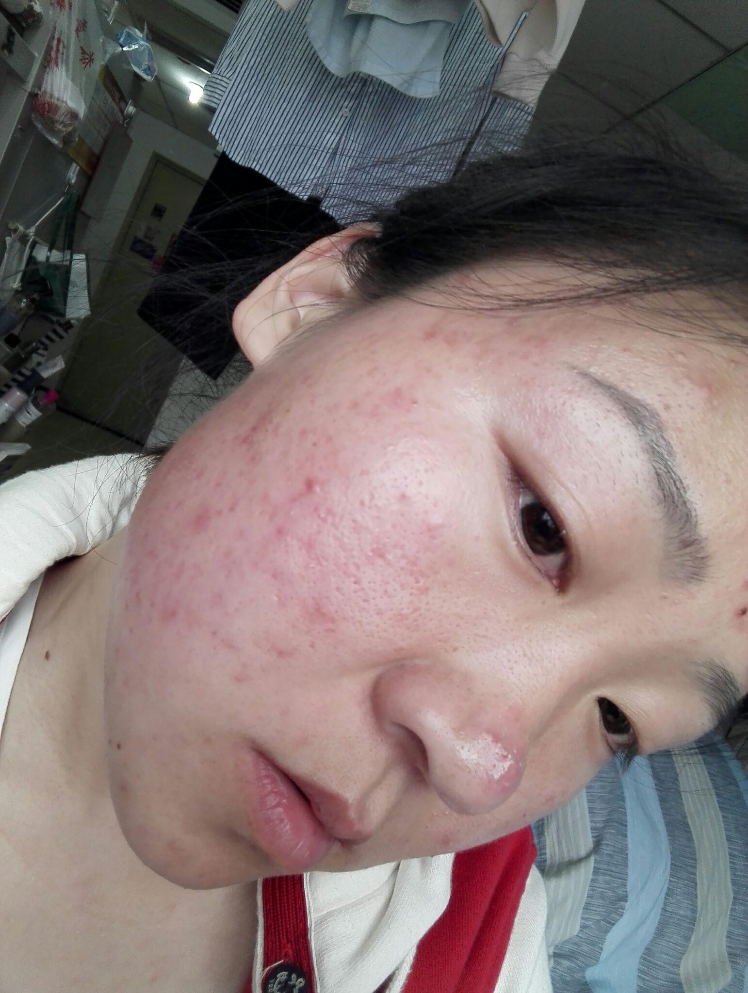 满脸痘痘很自卑,怎么办? - 知乎